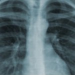 Anvisa aprova registro de novo medicamento para tuberculose
