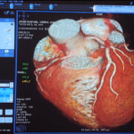 Mortes por infarte podem ser evitadas por exame, destaca estudo