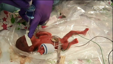 EUA: bebê com menos de 300 gramas sobrevive e tem alta de hospital