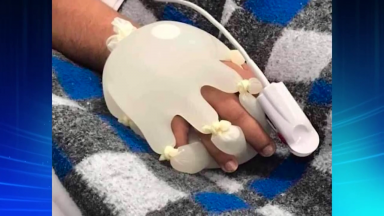 Enfermeira usa a criatividade para aquecer as mãos de doentes com covid