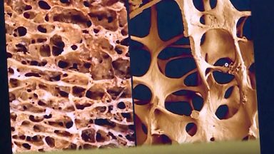 Estilo de vida saudável pode prevenir surgimento de osteoporose 