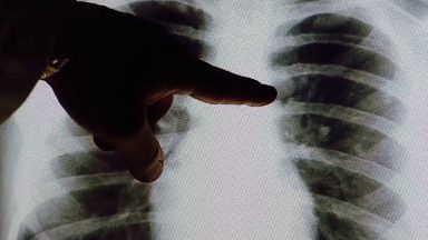Tabagismo é responsável por 85% dos casos de câncer no pulmão