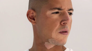 Dia Mundial do Vitiligo reforça o combate contra o preconceito